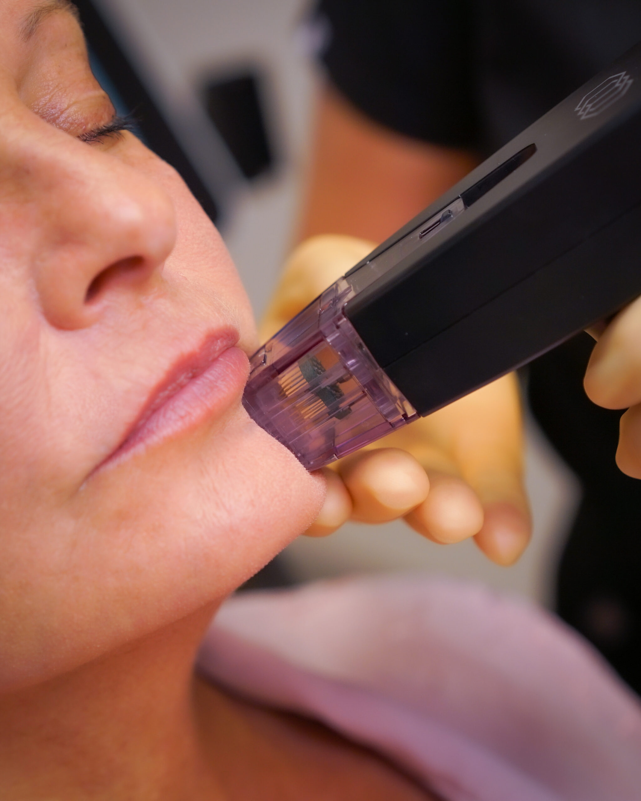 morpheus8 treatment morpheus8 treatment