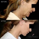 Before and after facial cosmetic treatment showing enhanced contours and rejuvenated appearance