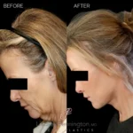 Before and after facial cosmetic treatment showing enhanced contours and rejuvenated appearance