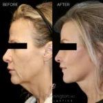 Before and after facial cosmetic treatment showing enhanced contours and rejuvenated appearance