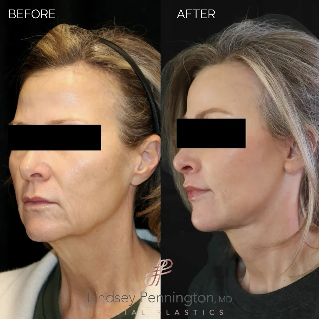Before and after facial cosmetic treatment showing enhanced contours and rejuvenated appearance