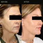 Before and after facial cosmetic treatment showing enhanced contours and rejuvenated appearance