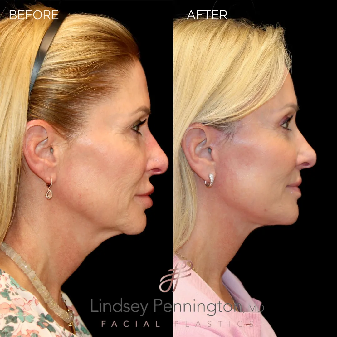 Before and after facial cosmetic treatment showing enhanced contours and rejuvenated appearance