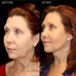 Before and after facial cosmetic treatment showing enhanced contours and rejuvenated appearance