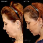 Before and after facial cosmetic treatment showing enhanced contours and rejuvenated appearance