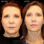 Before and after facial cosmetic treatment showing enhanced contours and rejuvenated appearance