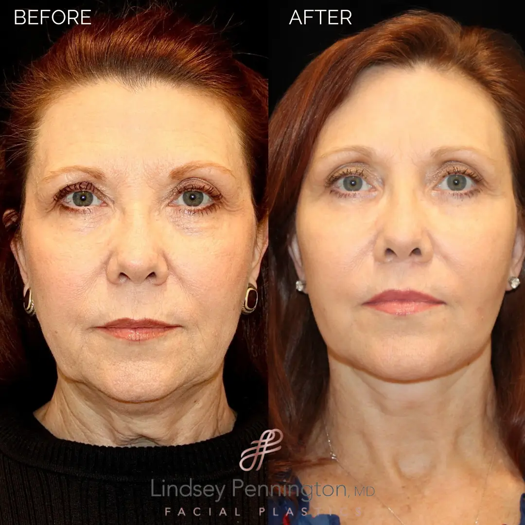 Before and after facial cosmetic treatment showing enhanced contours and rejuvenated appearance