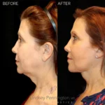 Before and after facial cosmetic treatment showing enhanced contours and rejuvenated appearance