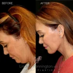 Before and after facial cosmetic treatment showing enhanced contours and rejuvenated appearance