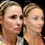 Before and after facial cosmetic treatment showing enhanced contours and rejuvenated appearance