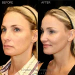 Before and after facial cosmetic treatment showing enhanced contours and rejuvenated appearance