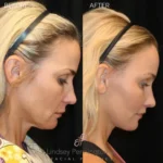 Before and after facial cosmetic treatment showing enhanced contours and rejuvenated appearance
