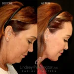 Before and after facial cosmetic treatment showing enhanced contours and rejuvenated appearance