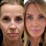 Before and after facial cosmetic treatment showing enhanced contours and rejuvenated appearance
