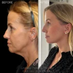 Before and after facial cosmetic treatment showing enhanced contours and rejuvenated appearance