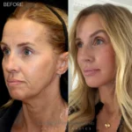 Before and after facial cosmetic treatment showing enhanced contours and rejuvenated appearance