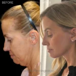 Before and after facial cosmetic treatment showing enhanced contours and rejuvenated appearance