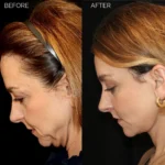 Before and after facial cosmetic treatment showing enhanced contours and rejuvenated appearance