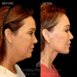 Before and after facial cosmetic treatment showing enhanced contours and rejuvenated appearance