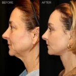 Before and after facial cosmetic treatment showing enhanced contours and rejuvenated appearance