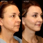 Before and after facial cosmetic treatment showing enhanced contours and rejuvenated appearance