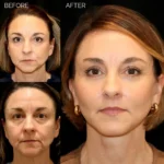 Before and after facial cosmetic treatment showing enhanced contours and rejuvenated appearance
