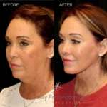 Before and after facial cosmetic treatment showing enhanced contours and rejuvenated appearance