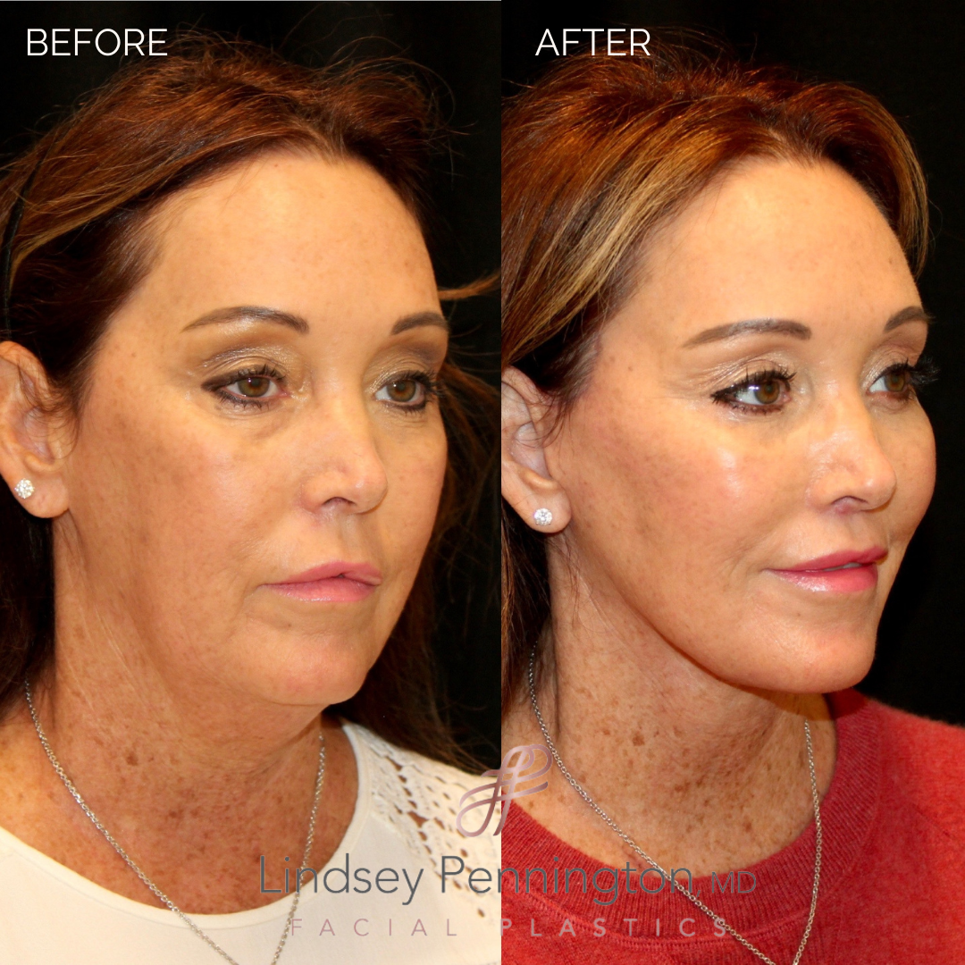 Before and after facial cosmetic treatment showing enhanced contours and rejuvenated appearance