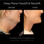 Before and after facial cosmetic treatment showing enhanced contours and rejuvenated appearance.