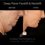 Before and after facial cosmetic treatment showing enhanced contours and rejuvenated appearance.