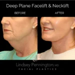 Before and after facial cosmetic treatment showing enhanced contours and rejuvenated appearance.