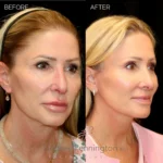Before and after facial cosmetic treatment showing enhanced contours and rejuvenated appearance