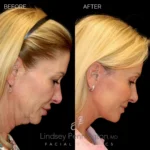 Before and after facial cosmetic treatment showing enhanced contours and rejuvenated appearance