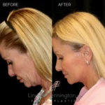Before and after facial cosmetic treatment showing enhanced contours and rejuvenated appearance