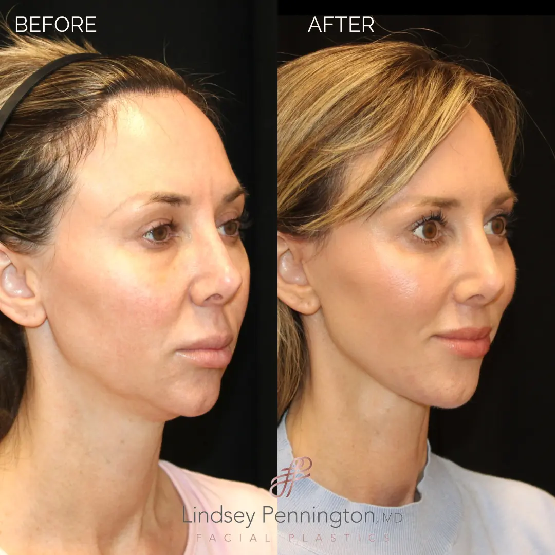 Before and after extended deep plane facelift, structural neck lift, endoscopic brow lift, lower lid blepharoplasty, fat grafting, and lip lift.