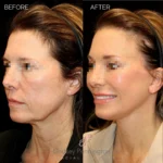 Before and after extended deep plane facelift, structural neck lift, endoscopic brow lift, upper and lower lid blepharoplasty, and fat grafting