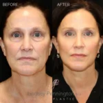 Before and after extended deep plane facelift, structural neck lift, lateral brow lift, transcutaneous lower lid blepharoplasty, laser resurfacing, and fat grafting.