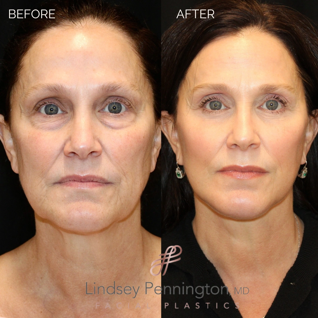 Before and after extended deep plane facelift, structural neck lift, lateral brow lift, transcutaneous lower lid blepharoplasty, laser resurfacing, and fat grafting.