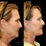 Before and after extended deep plane facelift, structural neck lift, endoscopic brow lift, upper and lower blepharoplasty, fat grafting with nano fat, lip lift, and laser resurfacing.