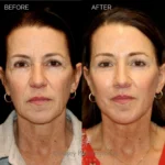 Before and after extended deep plane facelift, structural neck lift, endoscopic brow lift, open lower lid blepharoplasty, laser resurfacing, and PRP injections.