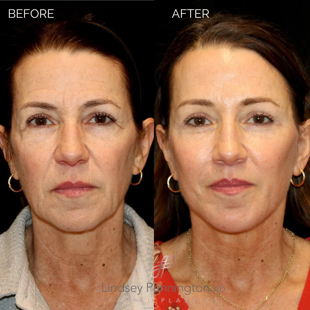 Before and after extended deep plane facelift, structural neck lift, endoscopic brow lift, open lower lid blepharoplasty, laser resurfacing, and PRP injections.