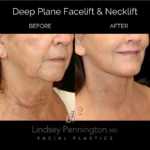 deep plane facelift necklift before and after