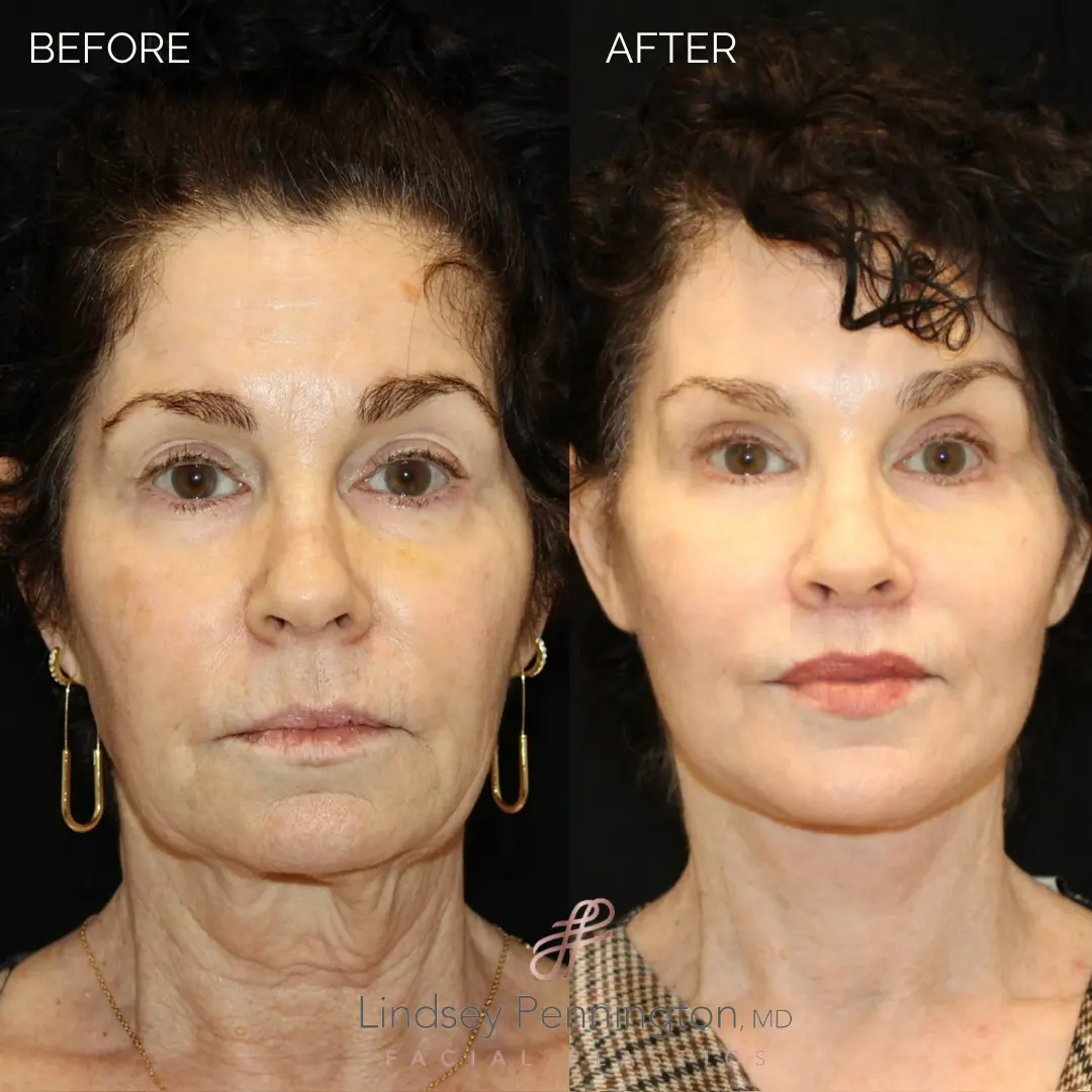 Before and after total facial rejuvenation: deep plane facelift, structural neck lift, endoscopic brow lift, upper/lower blepharoplasty, lip lift, fat grafting, laser resurfacing, and earlobe reduction.