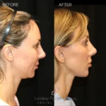 Before and after extended deep plane facelift, structural neck lift, endoscopic brow lift, lower lid blepharoplasty, fat grafting, and lip lift.