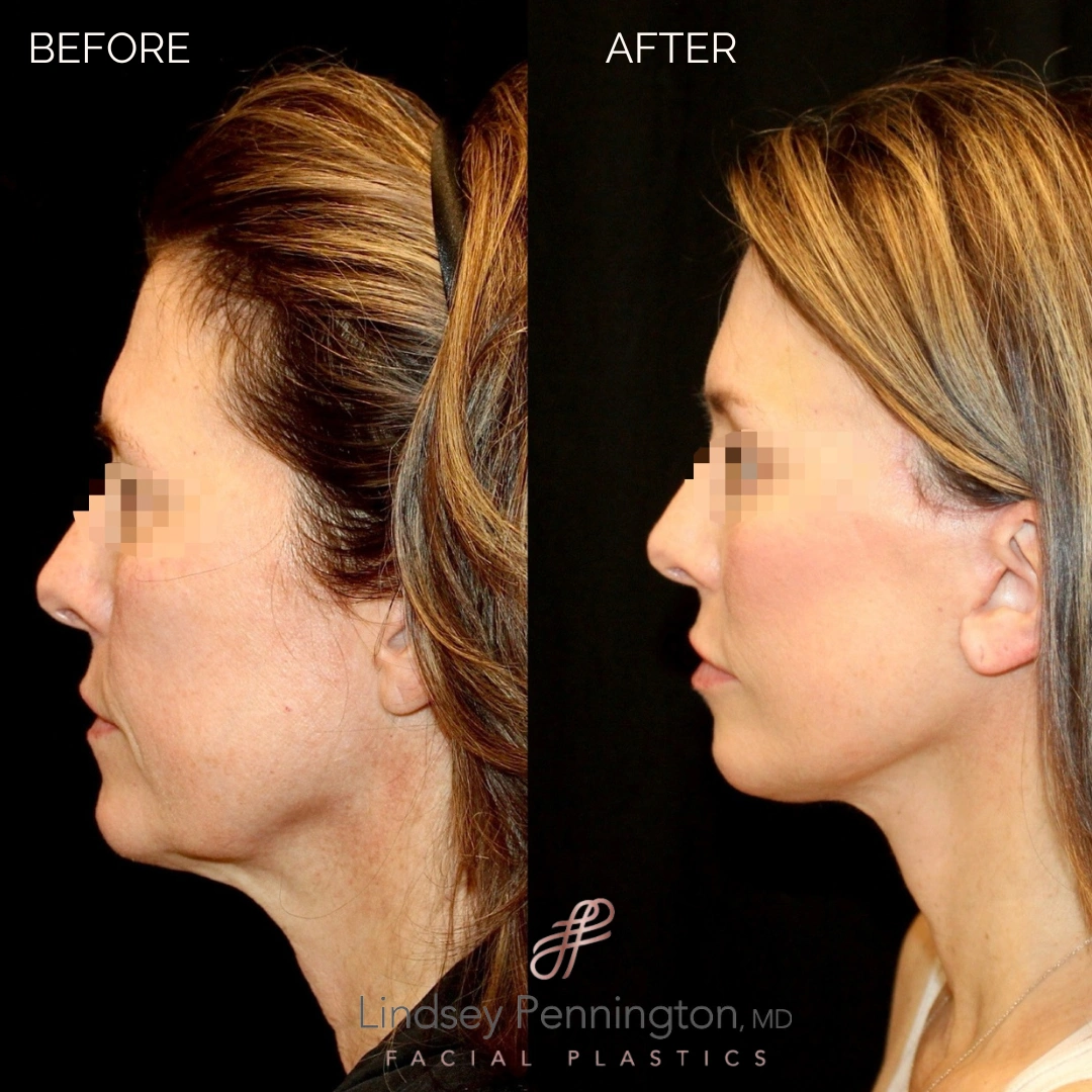 Before and after extended deep plane facelift, structural neck lift, endoscopic brow lift, upper and lower lid blepharoplasty, and fat grafting