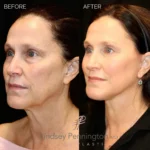 Before and after extended deep plane facelift, structural neck lift, lateral brow lift, transcutaneous lower lid blepharoplasty, laser resurfacing, and fat grafting.