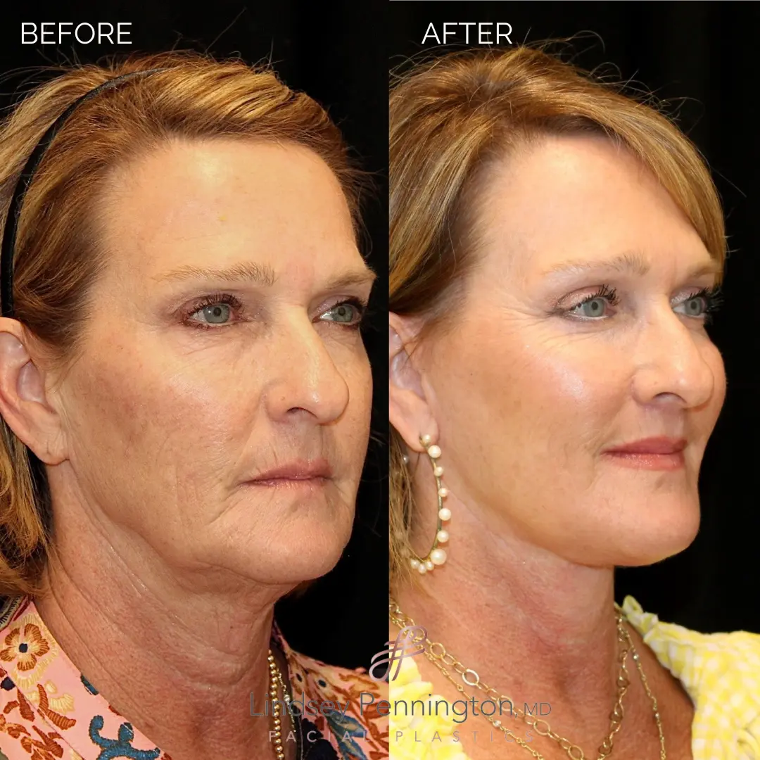 Before and after extended deep plane facelift, structural neck lift, endoscopic brow lift, upper and lower blepharoplasty, fat grafting with nano fat, lip lift, and laser resurfacing.