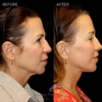 Before and after extended deep plane facelift, structural neck lift, endoscopic brow lift, open lower lid blepharoplasty, laser resurfacing, and PRP injections.