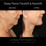 deep plane facelift necklift before and after