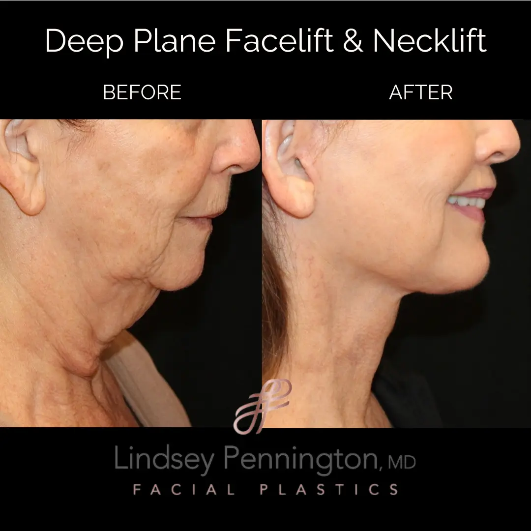 deep plane facelift necklift before and after